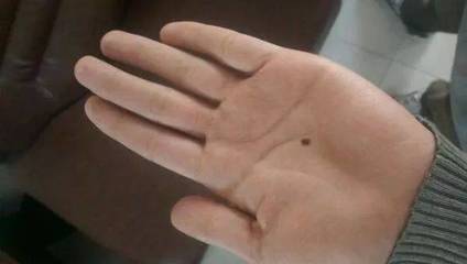 有“痣”者，須注意！磨擦可能帶來的健康風險